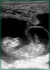 Ultraschall Fötus 7 Wochen alt